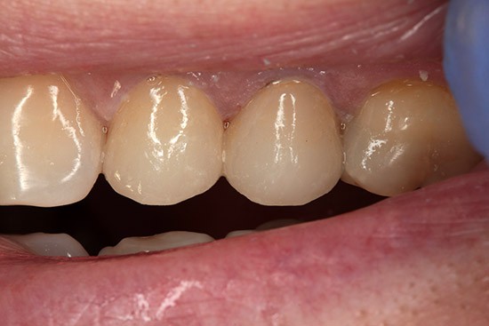 Po: endodontinis gydymas presuotos keramikos vainikėliais