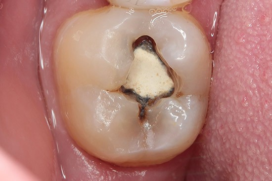 Prieš: krūminio danties didelis ėduonies pažeidimas po sena plomba